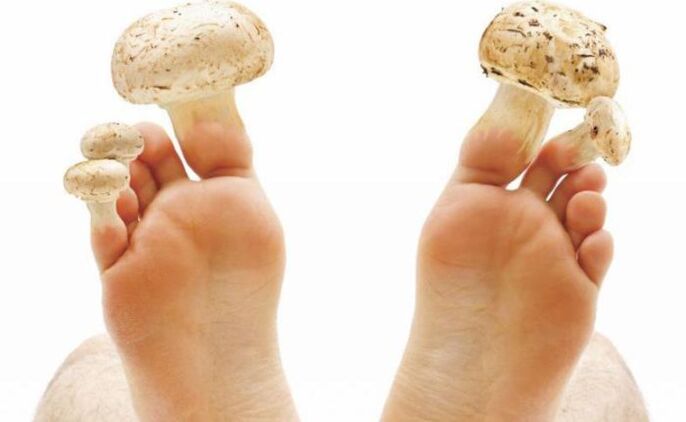 αιτίες, συμπτώματα και θεραπεία του μύκητα των ποδιών