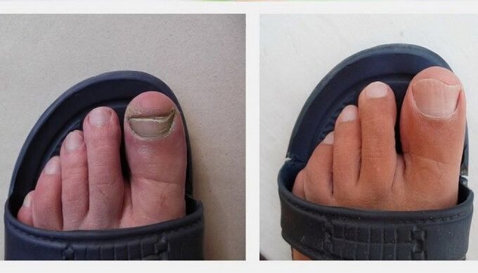 νύχια των ποδιών πριν και μετά τη θεραπεία του μύκητα με μηλόξυδο